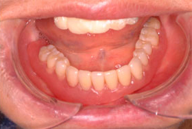 口腔内に義歯を装着した状態